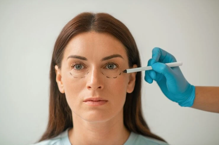 Preenchimento facial de olheiras